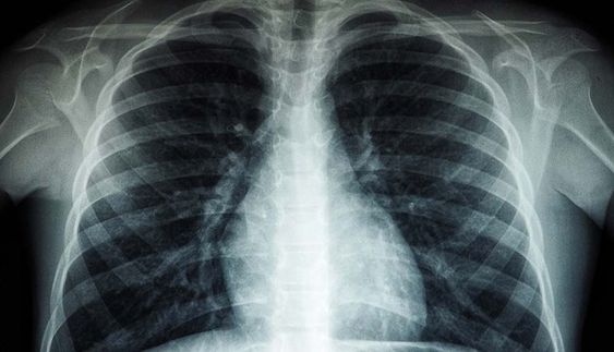 HOW IS TUBERCULOSIS INFECTION?